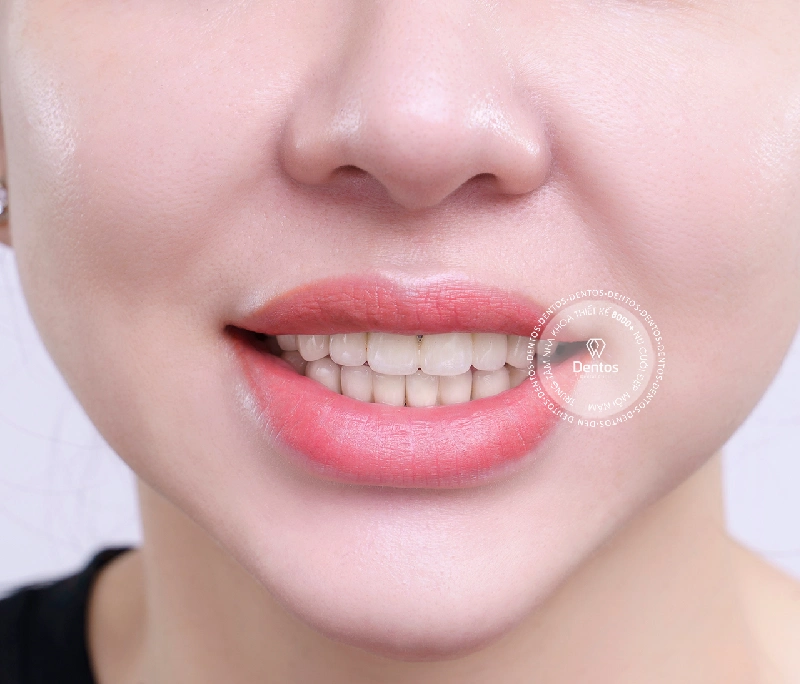 Tại sao răng sứ bị xỉn màu? Cách làm sáng răng sứ